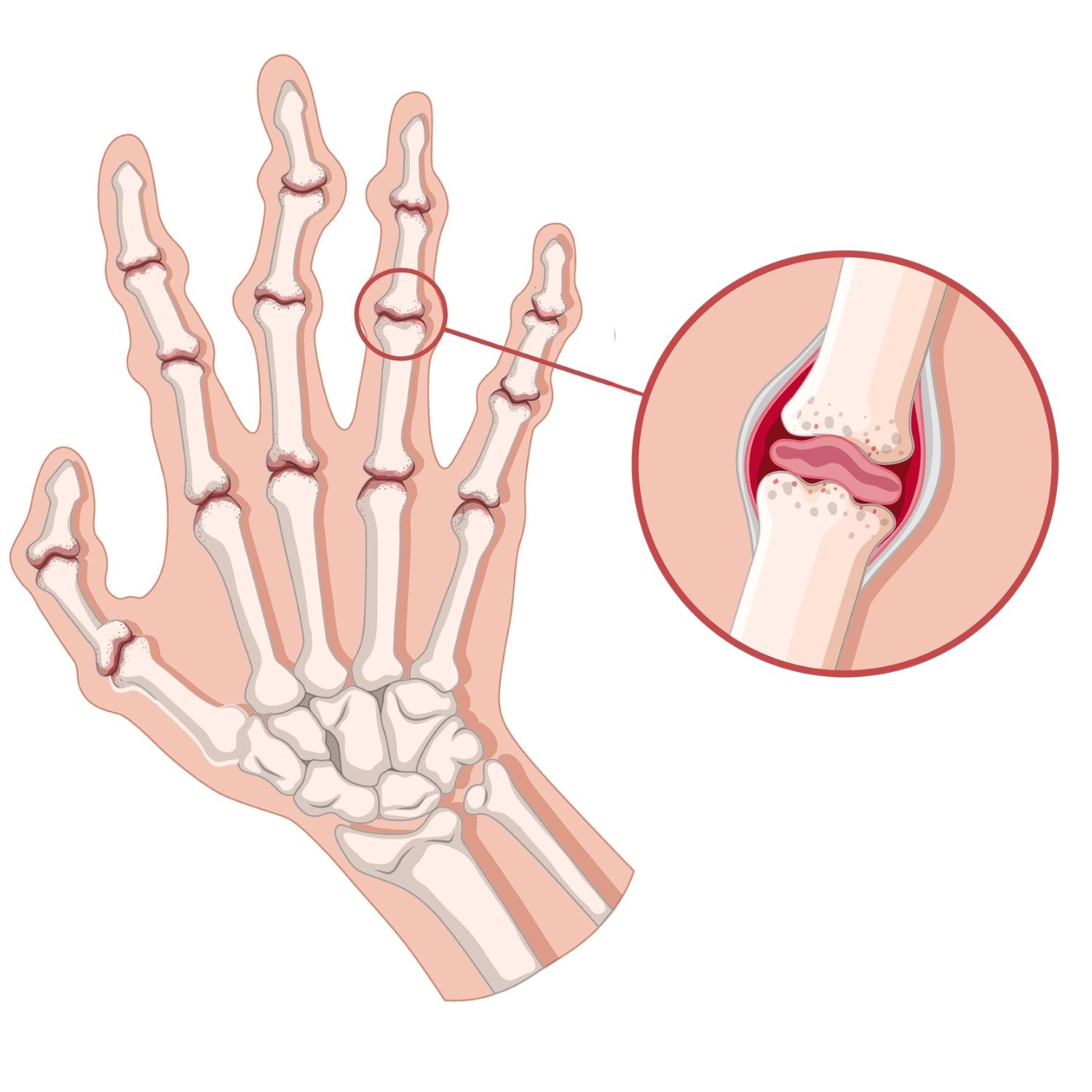 hand oa