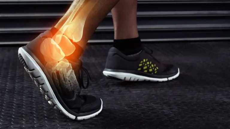 Ankle Arthritis