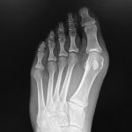 toe xray